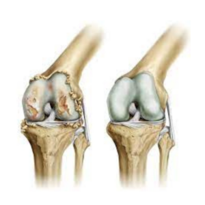 mitos e verdades sobre artrose no joelho